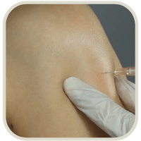 Intramuscular Injection