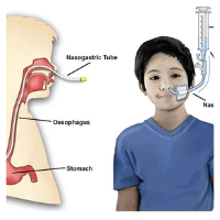 nasogastric tube insertion (NG Tube)
