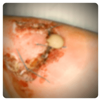 Infected wound dressing