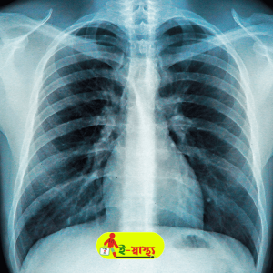 X Ray Chest (P/A)