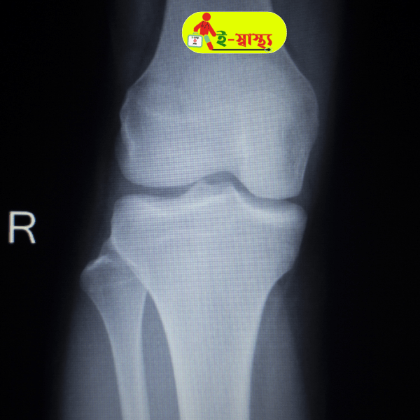 X Ray Knee Joint (B/V)