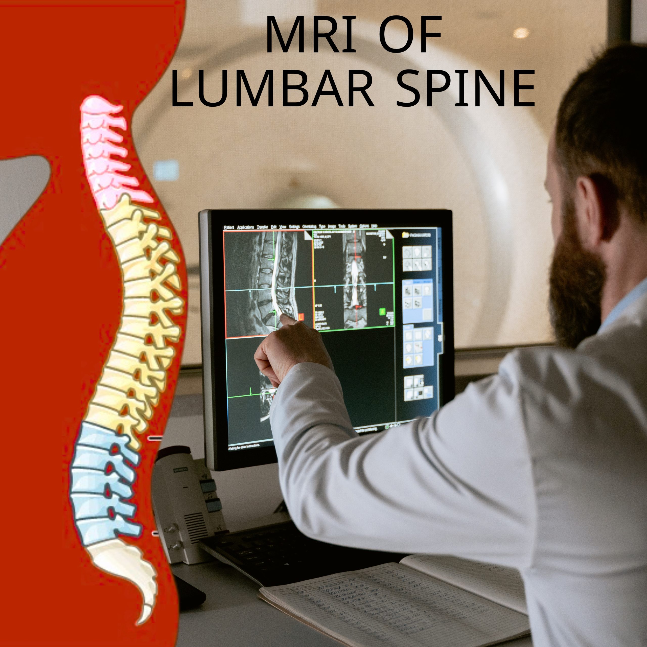 MRI of Lumbar Spine without Contrast